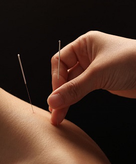 Acupuncture